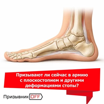 Плоскостопие и другие деформации стоп. Призывают ли в армию?